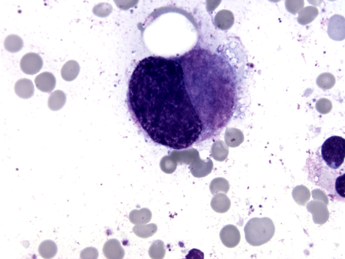 Bone marrow aspirate smear (BM-1), Wright-Giemsa stain, B, x1000